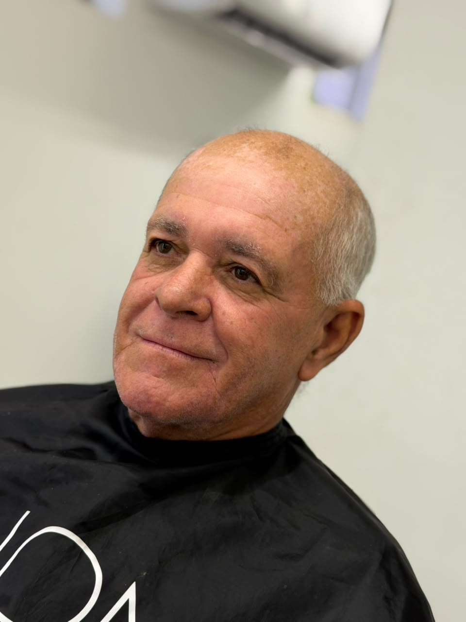 Antes — resultado de prótese capilar